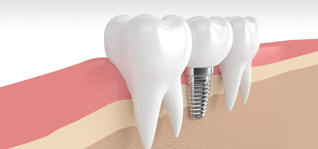 permanent tooth prosthesis Strategies For Beginners